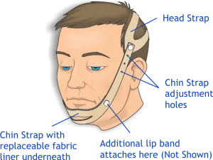 Urocare 6200 Anti-Snoring Strap. Includes: 1 Head Strap (#620001), 1 Chin Strap (#620002), 1 Lip Strap (#620004), 2 Chin Strap Liners (#620003), 4 Plastic Buttons (#603402), Illustrated Use And Care Instructions (#Pi6200)